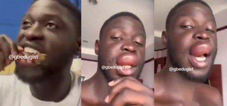Man Sparks Reactions Online After Waking Up With Swollen Lips Allegedly From Eating Frog