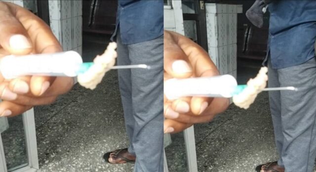 Mother Shares Shocking Ordeal as Doctors Remove Large Nylon from Toddler’s Nose